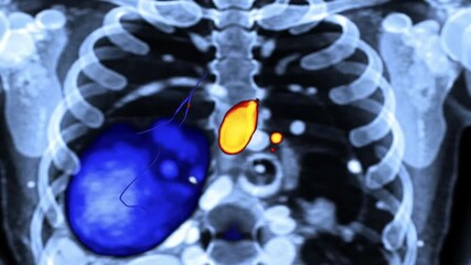 Medical Scan Video Heart and Ribcage XRay with Colored Overlay for Diagnosis