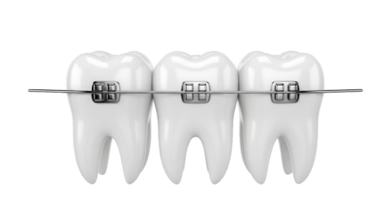 Close-up of three white teeth with metal braces attached in a low resolution transparent image
