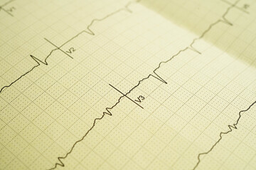 Electrocardiogram (ECG), heart wave, heart attack, cardiogram report.