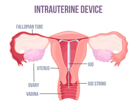 Lud. Intrauterine device placement in uterus, female contraception birth control copper or hormonal coil mirena iucd medical education preventive pregnancy neat vector illustration