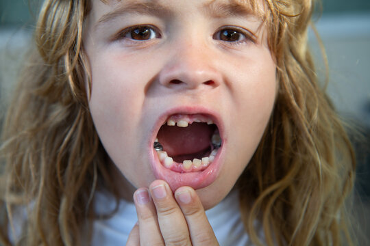 Portrait of funny kid with open mouth without front milk tooth. Loss primary teeth. Growth of permanent molar baby tooth. Child missing tooth. Tooth loss, teeth falling out. Dental kids face.