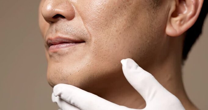 Cryolipolysis for Male Double Chin Reduction. Body contouring, aesthetics.