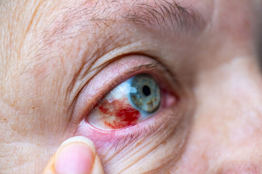 Close-up human eye with severe redness and broken blood vessels, showing subconjunctival hemorrhage, clinical detail for medical, health, and ophthalmology concepts, patient healing, blood vessel