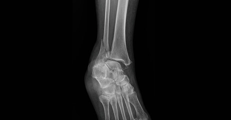 Mortise ankle X-ray showing tibia, fibula, ankle joint and foot bones. Medical imaging for...