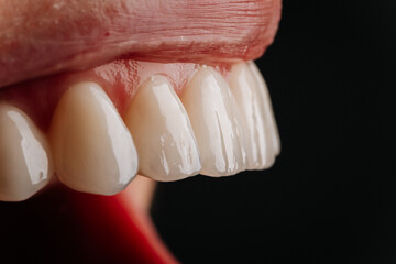 Macro side view of glossy porcelain veneers and natural lips on black background