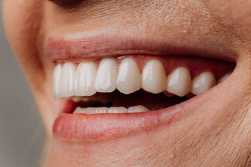 Closeup of bright white veneers on mature woman smile, natural dental result