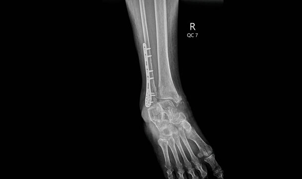 Lateral ankle X-ray showing distal tibia fracture with plate and screws fixation. Medical imaging for post-operative evaluation of ankle trauma surgery and orthopedic hardware assessment.