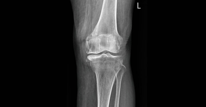 Anteroposterior knee X-ray showing femur, tibia, fibula, patella and knee joint anatomy. Medical diagnostic imaging for orthopedic evaluation, arthritis assessment and joint structure analysis.