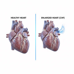 Heart vs Healthy Heart Comparison