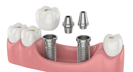Dental implants and crowns isolated on a transparent background