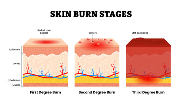 Stages of skin burn stage, first, second and third degree burn. Wound after burn. Types of injury to skin. Human skin layers anatomy cross section. Vector illustration.