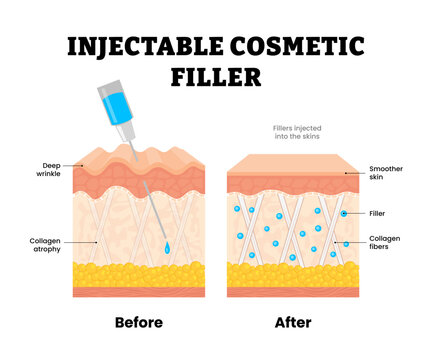 Before after injectable cosmetic filler procedure injection. Beauty treatment, Collagen atrophy and Deep wrinkle, smoother skin. Human skin layers anatomy cross section. Vector illustration.