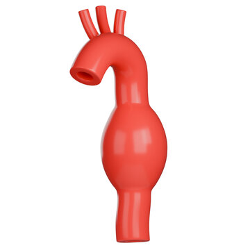 3D medical illustration of a fusiform aortic aneurysm, shows spindle shaped bulging of the aorta.