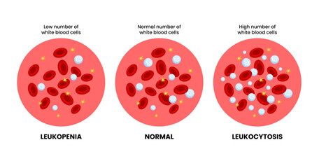 Leukopenia, normal blood vs Leukocytosis specimen blood composition comparison. Human blood cells structure. Thrombocytes, leukocytes, erythrocytes under microscope. Microbiology test. Blood disorder