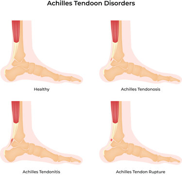 Achilles Tendon Disorders Healthy Tendonosis Tendonitis Rupture Comparison Vector Illustration