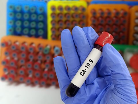 Doctor  holding a test blood sample for CA-19.9 test. Laboratory medical testing concept.