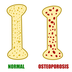 comparison of normal hea;thy bone versus bone with osteoporosis medical illustraion disease.eps