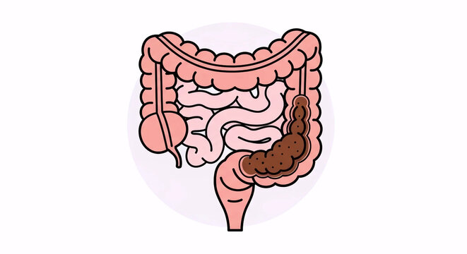 Intestines with Severe Constipation/Blockage, Digestive Health Illustration