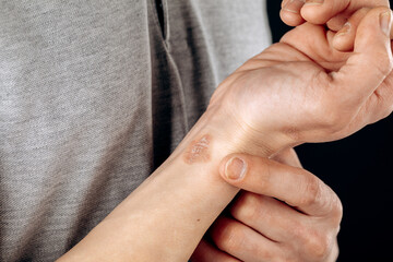 Close-up of men's hands with dry skin damage. The concept of dermatology is human hands with skin with cracks and wounds.