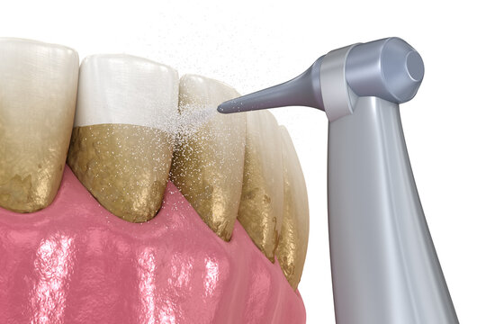 Oral hygiene: Air flow teeth cleaning process. Dental 3D illustration