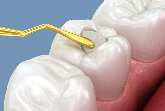 Toth restoration with filling. Tooth 3D illustration.