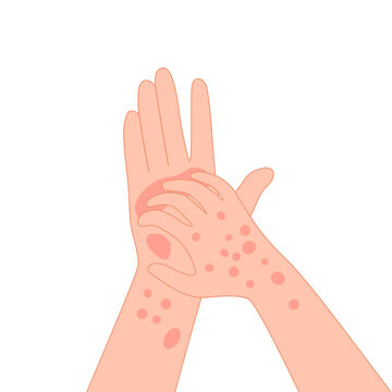 Rash skin on hand. Rashes itching hands scratch arm in red spot, dermatitis allergy symptoms itchy hives medicine pele virus eczema urticaria irritation disease vector illustration of skin disease