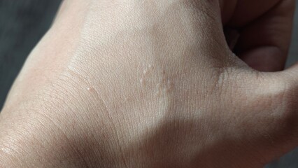 Itching on hands. Skin eczema.