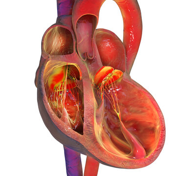 Left ventricular dilation, 3D illustration