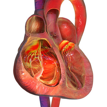 Right ventricular hypertrophy and dilation, 3D illustration