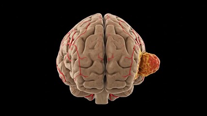 Realistic 3D Rendering of a Human Brain with a Tumor on the Occipital Lobe, Illustrating a Medical Condition