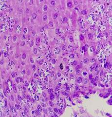 Endoscopic biopsy of oesophagus, microscopically show hyperplastic oesophageal mucosa, fibrinopurulent exudate and many spores of candida. Candidiasis.