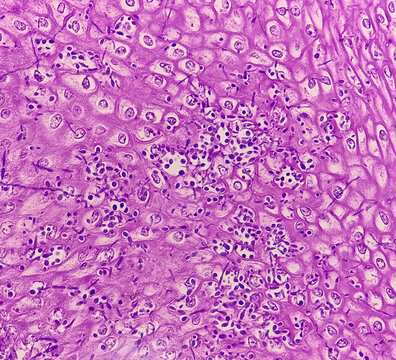 Endoscopic biopsy of oesophagus, microscopically show hyperplastic oesophageal mucosa, fibrinopurulent exudate and many spores of candida. Candidiasis.