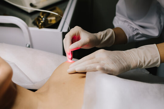 Laser therapy eliminates nevi, papillomas, and other cutaneous lesions. Laser excision of benign neoplasms on the body. Laser removal of nevi and fibromas close-up.