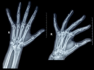 Post operative x-ray distal interphalangeal joint fusion arthrodesis of the proximal ring finger with splint pin