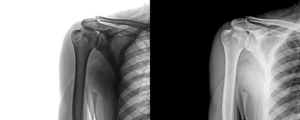 Shoulder Anterior Projection X-Ray Image Bone Structure for Assessment of Degenerative Conditions and Injuries Isolated on Transparent Background