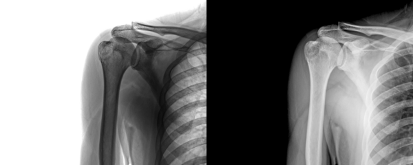 Shoulder Anterior Projection X-Ray Image Bone Structure for Assessment of Degenerative Conditions and Injuries Isolated on Transparent Background