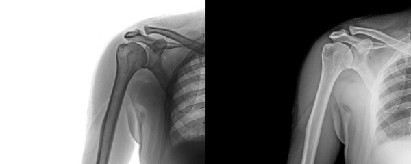 Shoulder Joint Anterior Projection X-Ray Radiograph Depicting Bone Anatomy for Diagnosis of Degenerative Changes and Injury Risk Isolated on Transparent Background