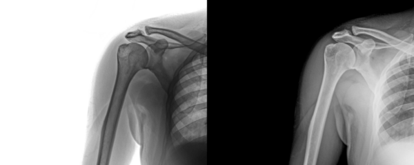 Shoulder Joint Anterior Projection X-Ray Radiograph Depicting Bone Anatomy for Diagnosis of Degenerative Changes and Injury Risk Isolated on Transparent Background