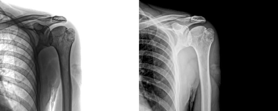 Shoulder Anterior View X-Ray Image Showing Detailed Structure of Joint and Diagnosis and Prognostic Evaluation Isolated on Transparent Background