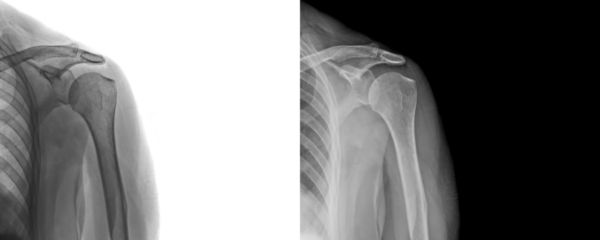 Shoulder Anterior View X-Ray Image Displaying Bone Structure and Soft Tissue Integrity for Diagnosing Degenerative Diseases and Injury Prognosis Isolated on Transparent