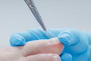 Ingrown toenail treatment with brace application by gloved hand and tool, podiatrist treatment