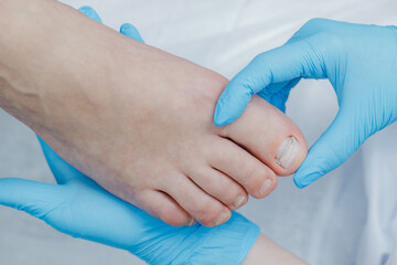 Foot examination by medical professional in blue gloves, after ingrown toenail recovery with brace titanium thread, podiatrist treatment