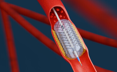 3d Illustration of Balloon Angioplasty.