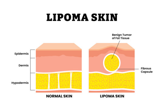 Normal vs Lipoma skin structure anatomy cross section. Benign tumor of fat tissue and fibrous capsule. Adipose tumor or Fatty lump. Medical poster diagram vector illustration.