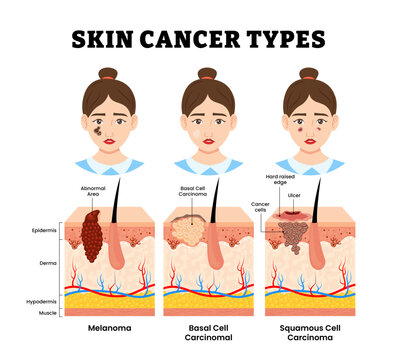 Different types of skin cancer type. Labeled woman or girl character, melanoma, basal cell carcinoma, squamous cell carcinoma, ulcer, tumor. Skin structure anatomy cross section. Vector illustration.