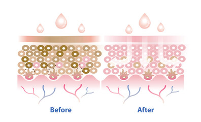 Before and after melasma treatment vector illustration isolated on white background. Cross section of melasma skin and skincare absorbing to help reduce hyperpigmentation, dark spots and damaged skin.