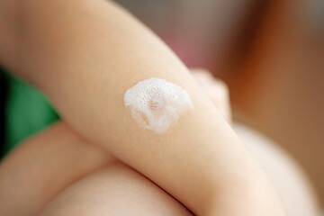 Teen's hand with minor thermal burn treated with medicinal pain-relief foam