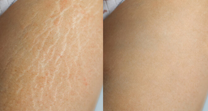 Image compare before and after Woman legs and hips with stretch marks removal treatment on white background.