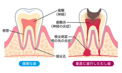 健康な歯と進行したむし歯　歯の内部構造
