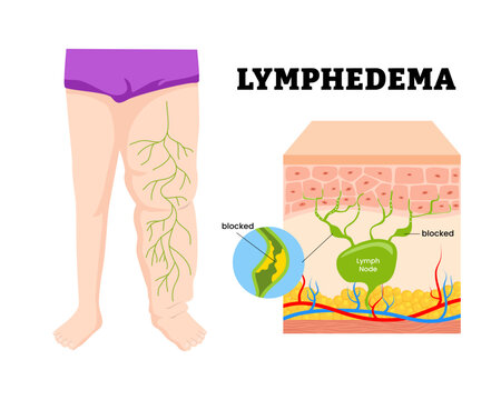 Lymphedema. buildup of lymph fluid, blocked lymph node on leg. Lymphatic system is blocked or damaged that cause swollen leg. Human skin layers anatomy cross section. Vector illustration